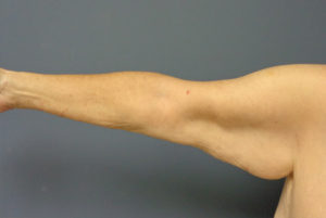 Arm Lift Before and After Pictures Nashville, TN