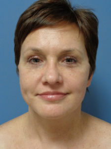 Facelift Before and After Pictures Nashville, TN