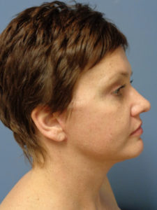 Facelift Before and After Pictures Nashville, TN