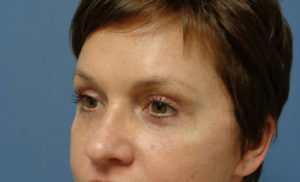 Blepharoplasty Before and After Pictures Nashville, TN