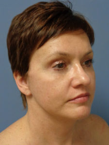 Facelift Before and After Pictures Nashville, TN