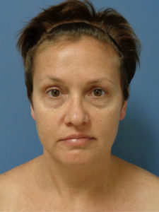 Facelift Before and After Pictures Nashville, TN