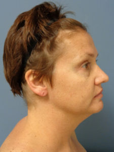 Facelift Before and After Pictures Nashville, TN