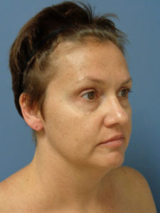 Facelift Before and After Pictures Nashville, TN