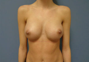 Breast Augmentation Before and After Pictures Nashville, TN