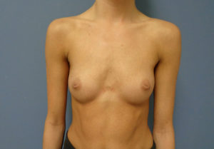 Breast Augmentation Before and After Pictures Nashville, TN