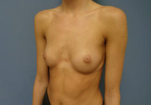 Breast Augmentation Before and After Pictures Nashville, TN