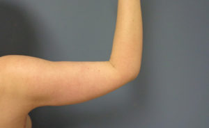 Arm Lift Before and After Pictures Nashville, TN