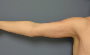 Arm Lift Before and After Pictures Nashville, TN