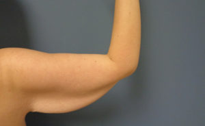 Arm Lift Before and After Pictures Nashville, TN