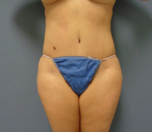 Tummy Tuck Before and After Pictures Nashville, TN