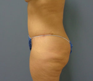 Tummy Tuck Before and After Pictures Nashville, TN