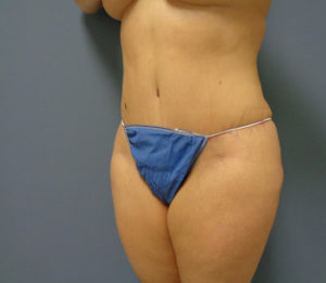 Tummy Tuck Before and After Pictures Nashville, TN