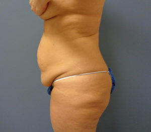 Tummy Tuck Before and After Pictures Nashville, TN