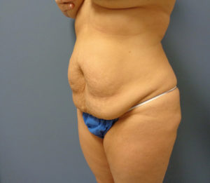 Tummy Tuck Before and After Pictures Nashville, TN