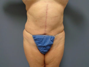 Tummy Tuck Before and After Pictures Nashville, TN