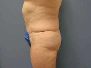 Tummy Tuck Before and After Pictures Nashville, TN