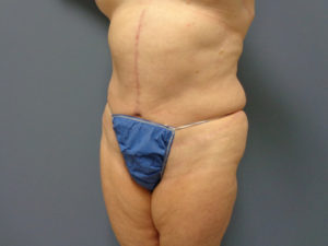 Tummy Tuck Before and After Pictures Nashville, TN