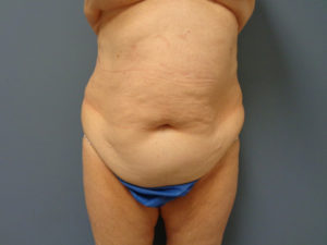 Tummy Tuck Before and After Pictures Nashville, TN