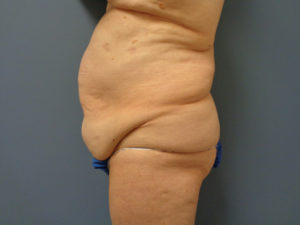 Tummy Tuck Before and After Pictures Nashville, TN