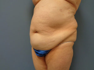 Tummy Tuck Before and After Pictures Nashville, TN