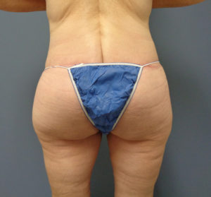 Butt Augmentation Before and After Pictures Nashville, TN