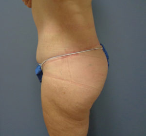 Butt Augmentation Before and After Pictures Nashville, TN