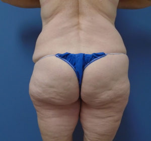 Butt Augmentation Before and After Pictures Nashville, TN