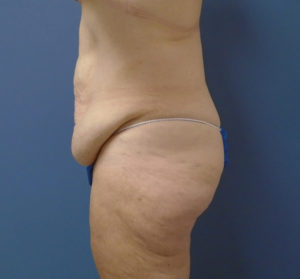 Butt Augmentation Before and After Pictures Nashville, TN