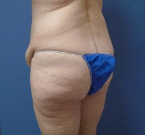 Butt Augmentation Before and After Pictures Nashville, TN