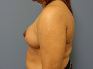 Breast Reduction Before and After Pictures Nashville, TN