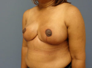 Breast Reduction Before and After Pictures Nashville, TN