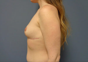 Implant Exchange/Removal Before and After Pictures Nashville, TN