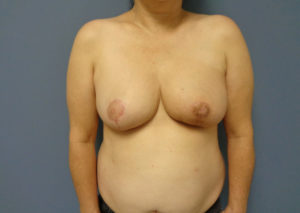 Breast Reconstruction Before and After Pictures Nashville, TN