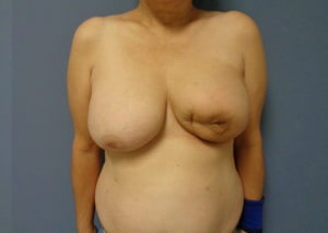 Breast Reconstruction Before and After Pictures Nashville, TN