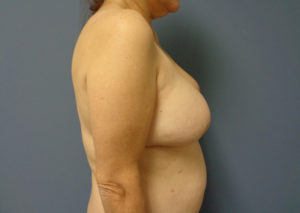 Breast Reconstruction Before and After Pictures Nashville, TN