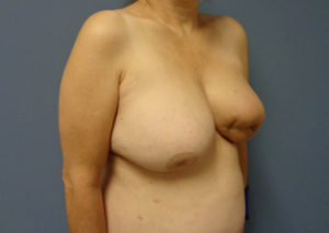 Breast Reconstruction Before and After Pictures Nashville, TN