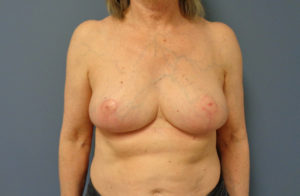 Breast Reduction Before and After Pictures Nashville, TN