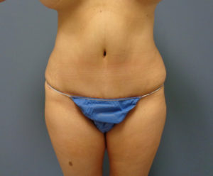 Tummy Tuck Before and After Pictures Nashville, TN