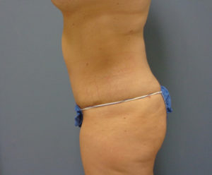 Tummy Tuck Before and After Pictures Nashville, TN