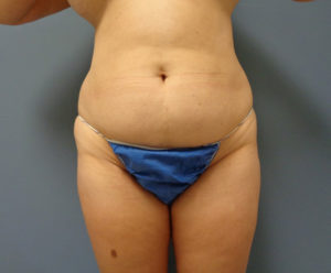 Tummy Tuck Before and After Pictures Nashville, TN