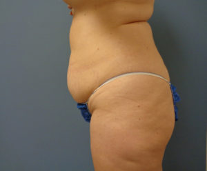 Tummy Tuck Before and After Pictures Nashville, TN