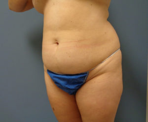 Tummy Tuck Before and After Pictures Nashville, TN