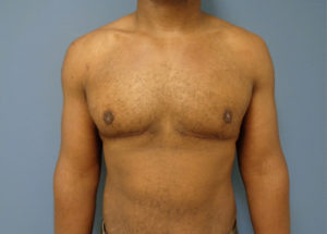 Gynecomastia Before and After Pictures Nashville, TN