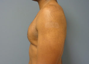 Gynecomastia Before and After Pictures Nashville, TN