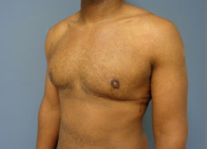 Gynecomastia Before and After Pictures Nashville, TN