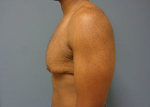 Gynecomastia Before and After Pictures Nashville, TN