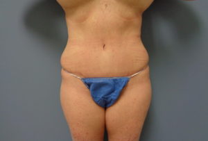 Tummy Tuck Before and After Pictures Nashville, TN