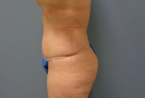 Tummy Tuck Before and After Pictures Nashville, TN