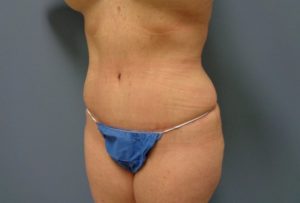 Tummy Tuck Before and After Pictures Nashville, TN